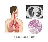 특발성 폐섬유화증(자료사진) [서울아산병원 제공]