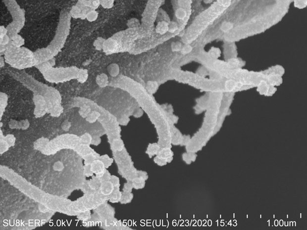 바이러스에 감염된 또 다른 세포의 전자현미경 이미지./사진=UC샌프란시스코(UCSF)