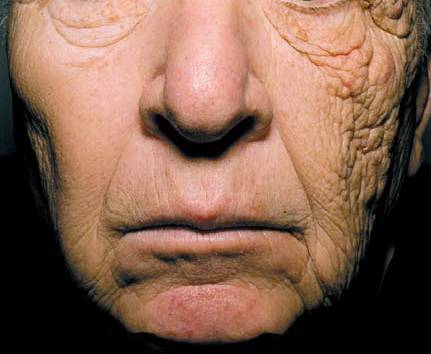 미국서 28년간 배달 트럭을 운전한 69세 남성의 얼굴 모습 [국제학술지 NEJM 논문 발췌]