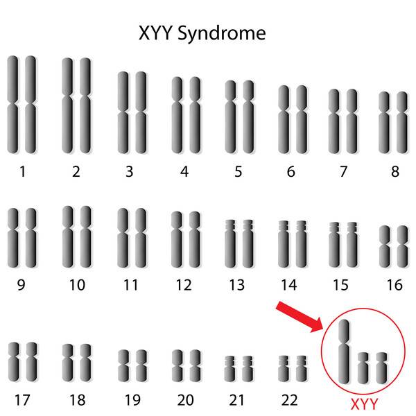 XYY 증후군 환자의 핵형. 빨간색 화살표는 XYY 염색체를 가리킨다. 출처 미국 국립보건원