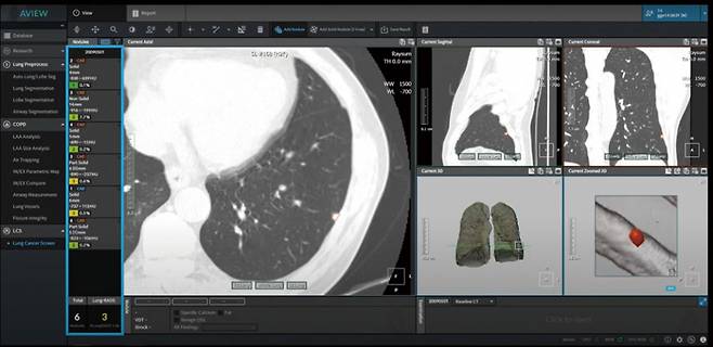 코어라인소프트의 주력 제품이자 폐암 검진 SW인 'AVIEW LCS' ⓒ코어라인소프트 제공