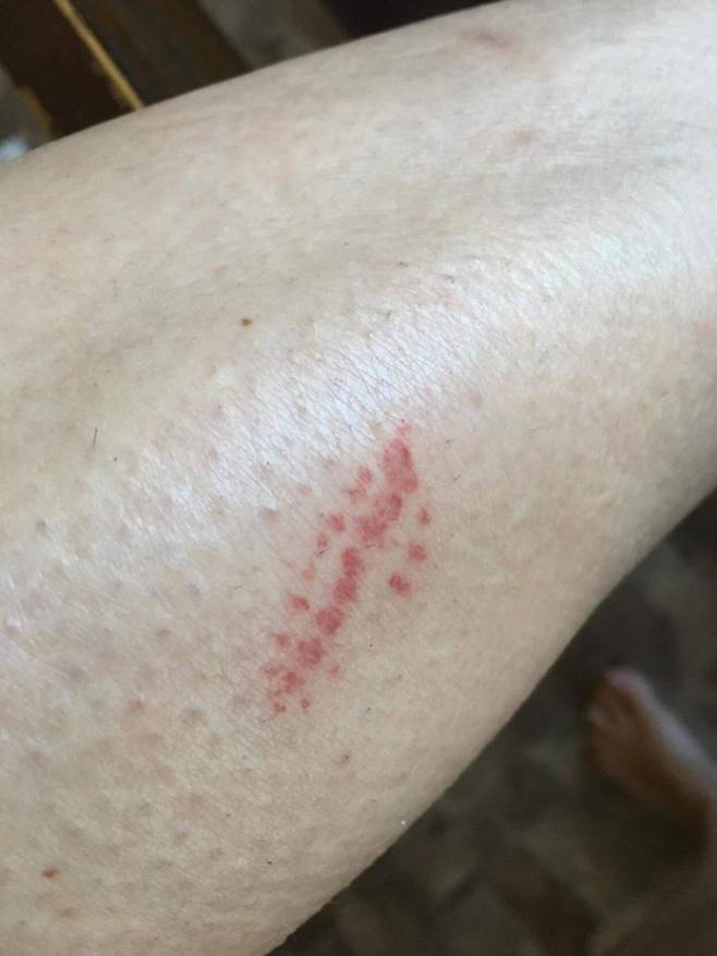 크리스털 개스턴의 오른쪽 종아리 바깥쪽에는 남부 플란넬 나방 애벌레와의 접촉으로 화상을 입은 듯한 흉터가 생겼다.(사진=크리스털 개스턴 제공)