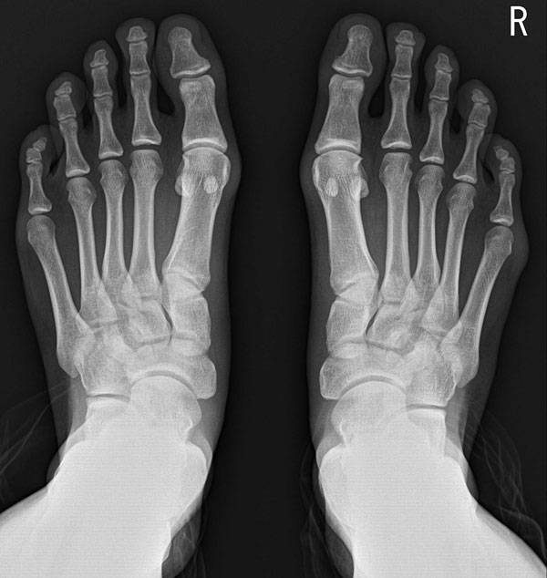 무지외반증과 소건막류가 동시에 있는 환자의 엑스레이 사진. / 연세건우병원 제공