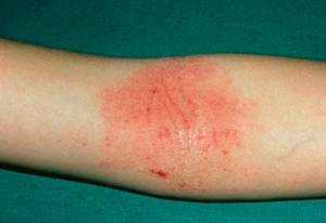 피부가 건조한 사람이 보습 관리에 소홀하면 건성 습진이 생길 수 있다/클립아트코리아 제공