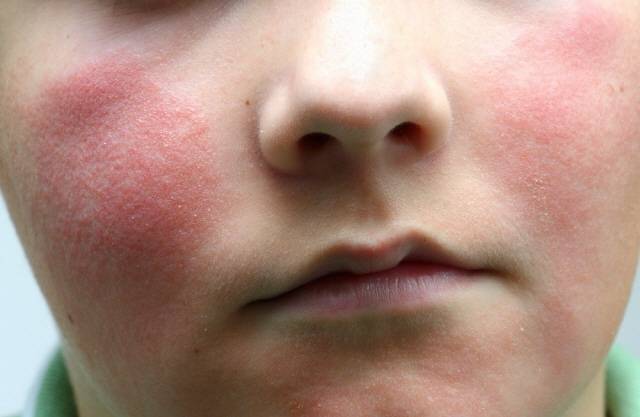 안면홍조는 자율신경이나 혈관 활성물질 등에 의해 혈관이 확장되며 발생한다./사진=클립아트코리아