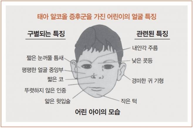 ▲태아알코올증후군을 가진 어린이의 얼굴 특징. 서적 '태아알코올증후군: 가정과 지역 사회를 위한 가이드'발췌.&nbsp;