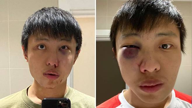 지난해 2월 인종차별적 폭행을 당했던 싱가포르 국적의 영국 유학생 피해자 조나단 목(24)의 당시 모습
