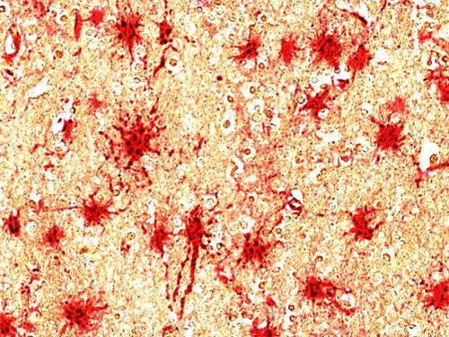 치매환자 뇌의 성상교세포(적색)에서 발현이 증가한 C8-감마 단백질(흑색) [석경호·류훈 교수 제공. 재판매 및 DB 금지]