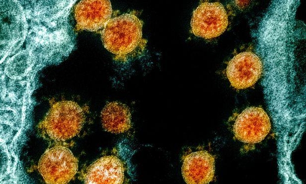 인체에 감염된 코로나 바이러스(주황색)의 전자현미경 사진. /미국 국립 알레르기·전염병 연구소(NIAID)