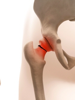 고관절 골절은 허벅지와 골반 부위를 잇는 부위가 골절되는 것을 말하는데, 노년층에 생기는 낙상 골절 사고 중 가장 주의해야 할 부상이다./클립아트코리아 제공
