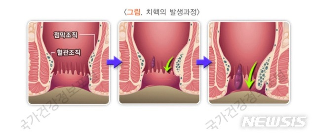 [서울=뉴시스] 치핵의 발생과정. (그림=질병관리청 국가건강정보포털 화면 캡쳐). 2021.02.04.