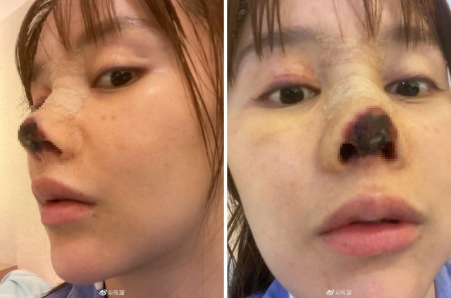 중국 배우 가오 류가 성형 후 코끝이 괴사하는 부작용을 겪고 있다. 웨이보 갈무리