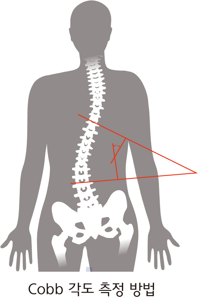 엑스레이 검사에서 커브 각도(Cobb’s angle) 10도 이상의 척추 변형을 ‘척추측만증’으로 진단한다. 커브 각도(Cobb’s angle) 측정 방법/인천성모병원 제공