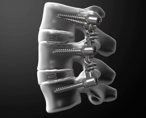 척추 수술 예시도 : 척추 전방부 디스크 자리에는 bio-functional cage, 척추 후방부에는 bioflex가 삽입