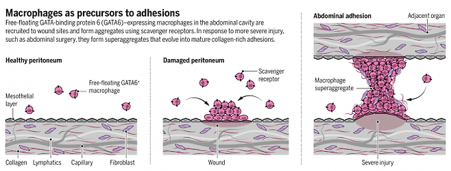 GATA6+대식세포가 복강 내 상처 부위를 봉한하는 과정과 유착이 생기는 과정을 나타낸 그림. 유착은 분리돼 있어야 할 두 조직이 연결되는 현상으로 외과수술을 받은 환자에게서 많이 나타난다. 불임, 만성 통증 등을 유발하며 증상이 심할 경우 재수술이 필요할 때도 있다. 사이언스 논문 캡처