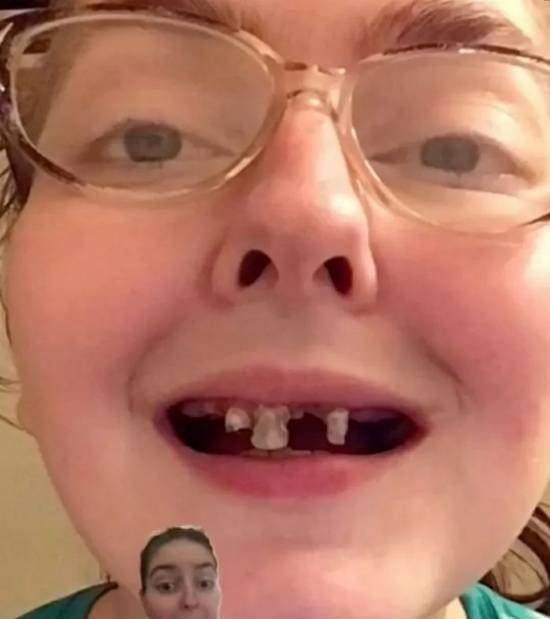 양치를 제대로 하지 않아 앞니가 다 썩어버린 빅토리아 아이린 노바코프스키. SNS 캡처