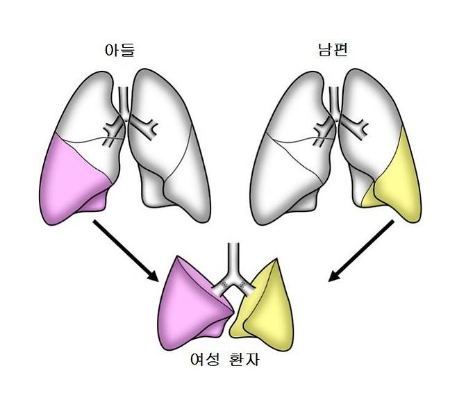 코로나19로 폐 기능 상실한 환자에게 생체 폐 이식 [교토대병원 제공 자료를 연합뉴스가 일부 재가공, 재판매 및 DB 금지]