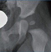 소아 고관절 이형성증은 아이들의 엉덩이 관절이 탈구되는 증상이다. 사진은 탈구된 엉덩이 관절을 찍은 X선 영상. 수리연 제공
