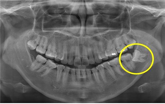 사랑니가 일부만 나와 있으며, 인접 치아에 손상을 주고 있다(노란색 원)./서울대치과병원 제공