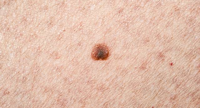 피부 암을 점으로 오인해 함부로 레이저 치료를 받다간 진단이 늦어질 수 있다./클립아트코리아