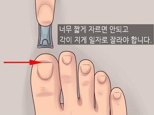 내성 발톱 깎는 법 / 선상규 원장 제공
