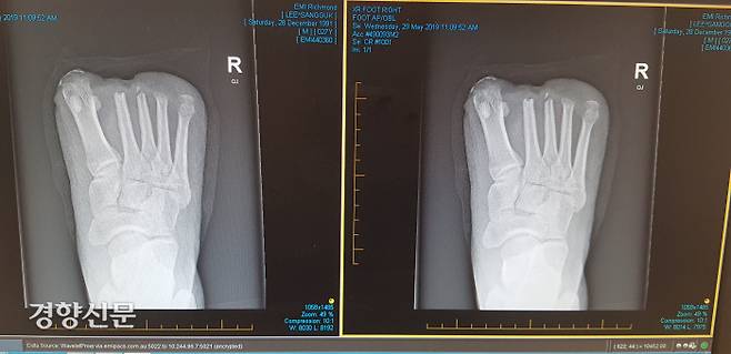 사고 이후 발가락이 잘린 이씨의 발 엑스레이 사진 / 이상국씨 제공