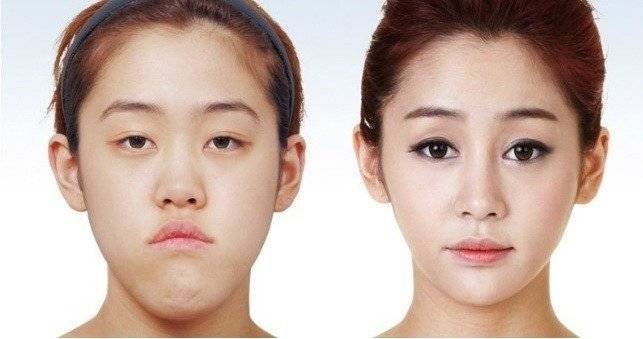 출처: 아이디성형외과