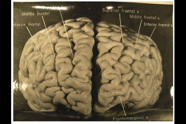출처: Brain(2012)/National Museum of Health and Medicine