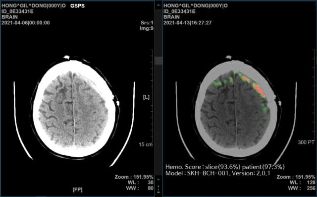 뇌출혈 영상판독 솔루션 동작 화면(이미지=SK(주) C&C)