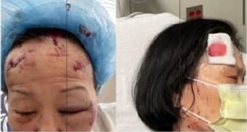 볼티모어에서 괴한 습격을 받은 여성들의 상처. 한 여성은 33바늘을  꿰맸다./유튜브 캡처