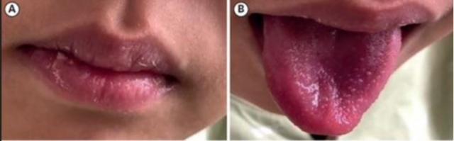 가와사키병의 주요 증상인 입술의 홍조와 갈라짐, 딸기 모양의 오톨도톨한 혀. 국민일보DB