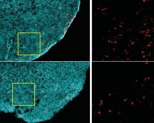 비만과 T세포 감소 암세포만 골라 죽이는 CD8+ T세포(적색)는, 비만한 생쥐(하단)보다 비만하지 않은 생쥐(상단)의 종양(청록색)에 더 많다.   [하버드의대 Ringel 등 제공 / 재판매 및 DB 금지]