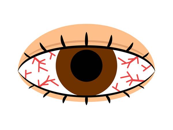 눈이 건조해 생긴 각막 신생혈관은 일단 생기면 사라지지 않는다./사진=클립아트코리아