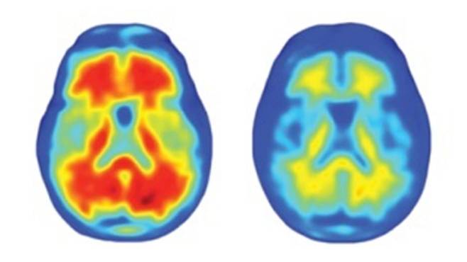 정상인(왼쪽)과 알츠하이머 치매 환자의 뇌 양전자 방출 단층촬영(PET) 영상. 정상인은 뇌에선 대사작용이 활발하게 일어나 영상이 노랗고 붉게 보이지만, 알츠하이머 환자는 뇌신경이 손상돼 대사작용이 줄어 파랗게 보인다./Nature