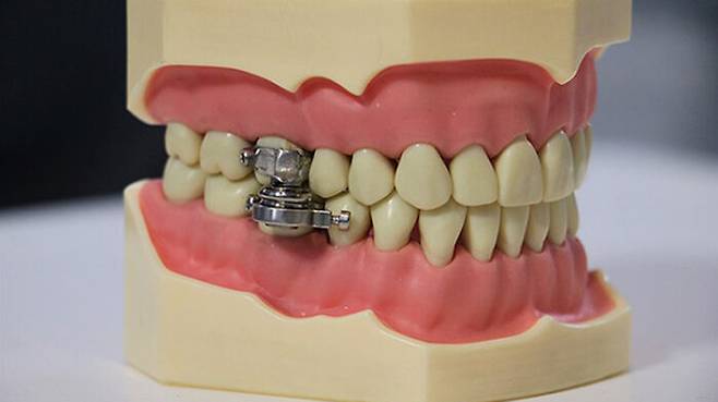 치아에 장착하는 살 빼기 장치 (사진=트위터 캡쳐)