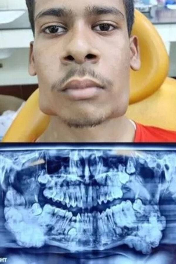 인도 17살 소년 턱에서 발견된 82개의 치아.