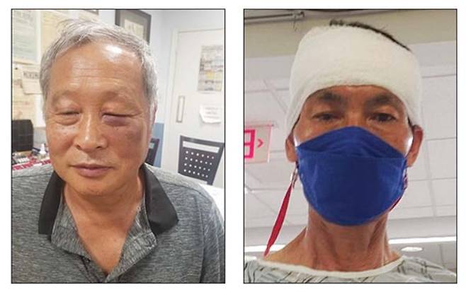 지난 9일(현지시간) 아마존 배달 직원으로부터 폭행을 당해 부상을 입은 한재열 뉴욕한인야구협회장(왼쪽)과 박우하 이사장의 모습 /사진제공=뉴욕한국일보, 한재열 회장