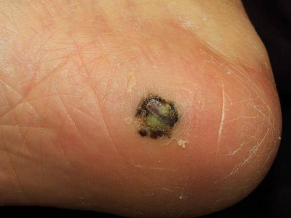 (서울=연합뉴스) 발바닥에 발생한 악성 흑색종. 1㎝ 이상의 크기와 불규칙한 경계와 색깔이 관찰됨. 2021.07.24. [서울대학교병원 제공. 재판매 및 DB 금지]