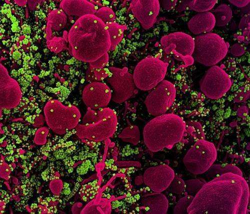 신종 코로나에 감염된 자멸사 세포 신종 코로나(녹색)에 감염된 애팝토시스(자멸사) 세포의 주사형 전자현미경 사진.
[미 NIAID(국립 알레르기 감염병 연구소)·NIH(국립 보건원) 제공 / 재판매 및 DB 금지]
