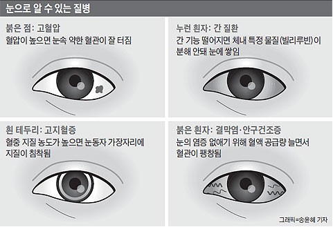 눈동자 바깥쪽에 흰 테두리가 생기면 고지혈증 때문일 수 있다./사진=조선일보 DB