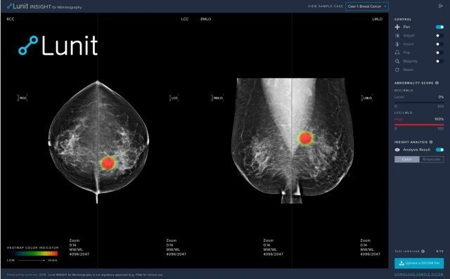 유방암을 진단하는 ‘루닛 인사이트 MMG’ 작동 화면. 유방암으로 의심되는 부분이 표시돼 있다.  루닛 제공