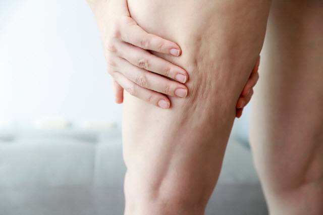 다리에 생긴 셀룰라이트./사진=클립아트코리아