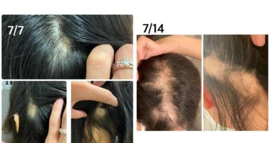 모더나 백신을 맞은 뒤 탈모가 시작됐다고 주장하는 일본 여성 [출처: 블로그]