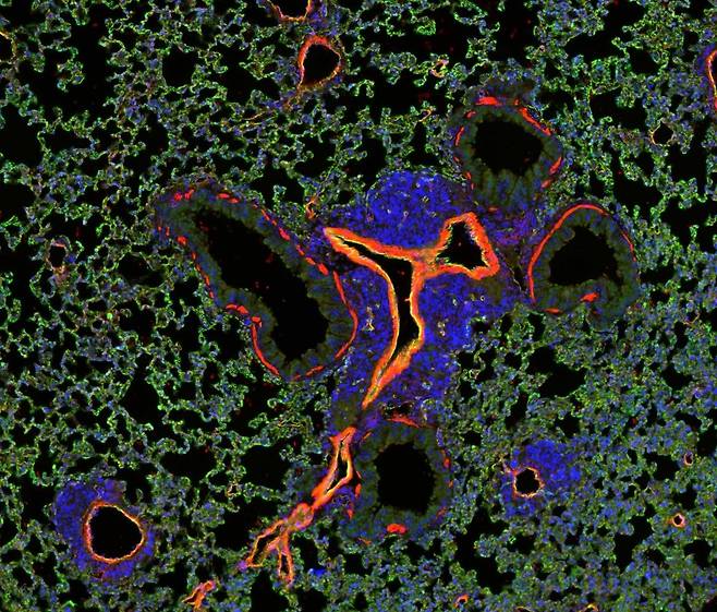 생쥐 폐에 생긴 전이암 폐혈관(적색) 주변에 성장한 종양 세포(청색)가 정상 조직(녹색)으로 파고들고 있다.
[저널 '사이언스 중개 의학' 논문 캡처 / 재판매 및 DB 금지]