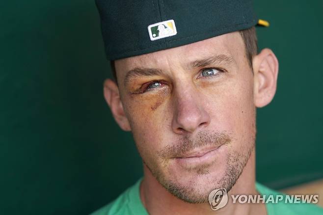 안면 수술받고도 복귀 앞둔 크리스 배싯 [AP=연합뉴스]