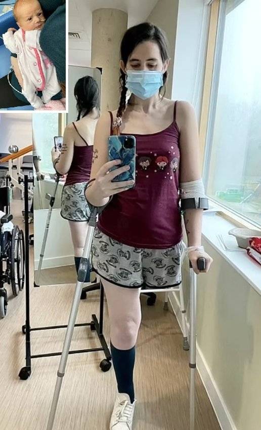 뱃속의 아기를 위해 다리 절단 수술을 한 영국 엄마 캐슬리 오스본. 캐슬리는 출산 8주 전 말기 암 진단을 받고 현재 항암 치료를 받고 있다. /사진=트위터 캡처