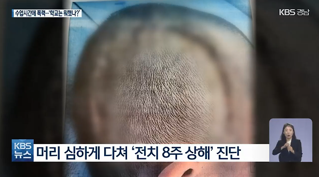 바닥과 벽에 머리를 부딪쳐 응급 수술을 받은 B군의 머리.