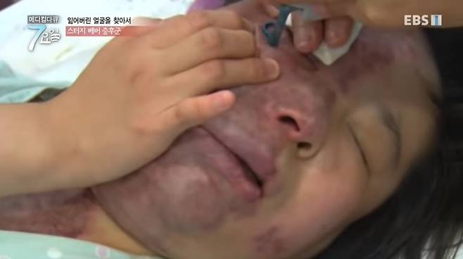 레이저 치료를 받고 있는 민혜 님. /사진=메디컬다큐 7요일 화면 캡쳐