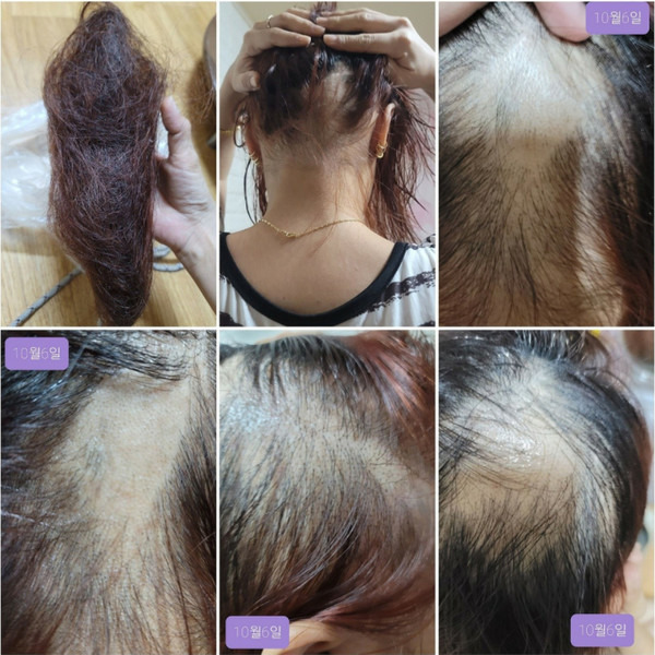 화이자 백신 접종 후 탈모를 겪고 있다며 '백신 부작용'으로 인정해달라는 글이 올라왔다. (온라인 커뮤니티 갈무리) © 뉴스1