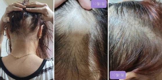 한 여성이 화이자 코로나19 백신 접종 후 탈모를 겪고 있다고 호소하는 국민청원을 올렸다. [온라인 커뮤니티 캡처]